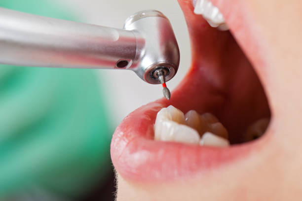 Best Dental Abscess Treatment in Osseo, MN